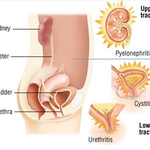 Urinary Tract Infection In Kid - Remedy For Urinary Tract Infections- A Natural Vaccine To Kill Uti Bacteria